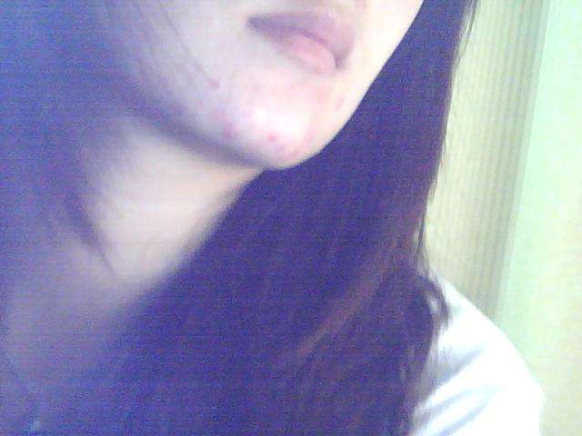 我的下巴总是反复长痘是怎么回事？