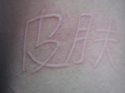 荨麻疹症状是什么样子的？如何治疗效果最好？