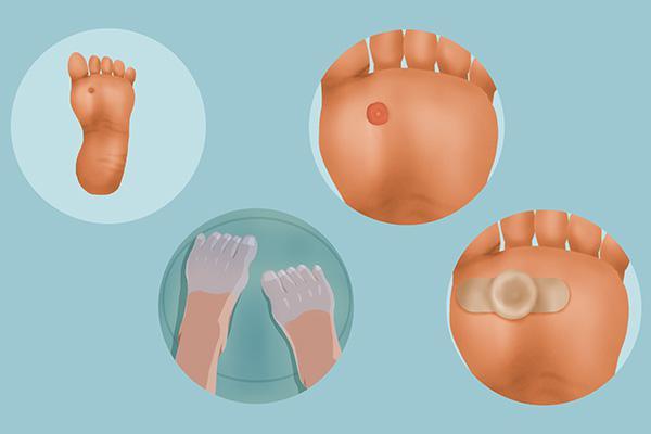 脚上长出鸡眼,如何根除？