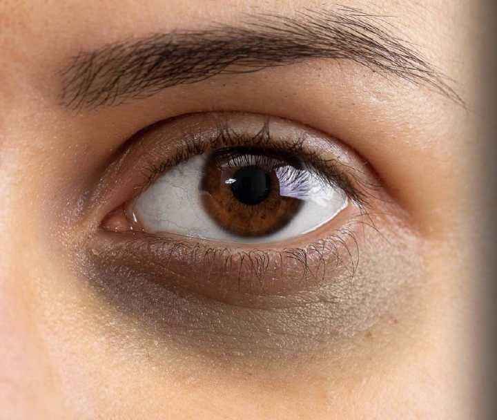 如何去除黑眼圈缓解效果比较快的方法