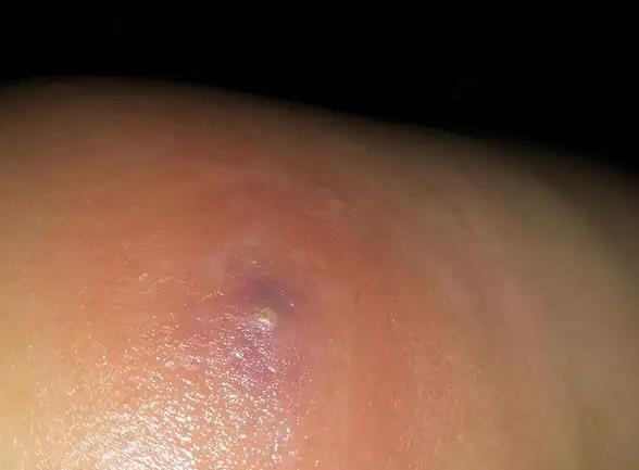 身上老长火疖子怎么办?