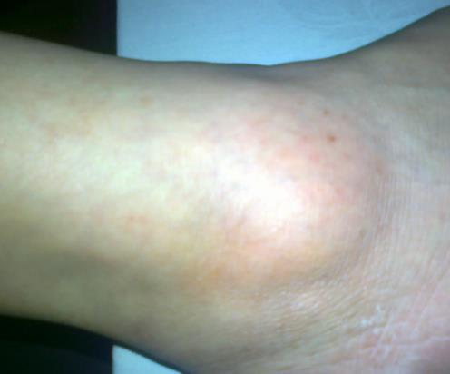 脚踝浮肿是什么原因引起的?