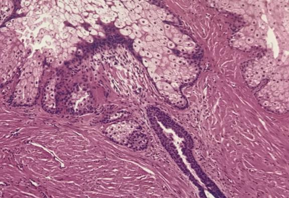 什么是蒙氏结节?