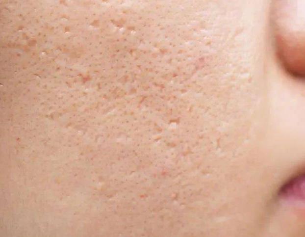 1681950811839265.jpg 痘坑痘印怎么祛除.jpg