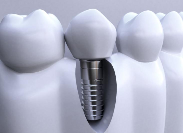 什么是种植牙?种植牙和补牙有什么区别?