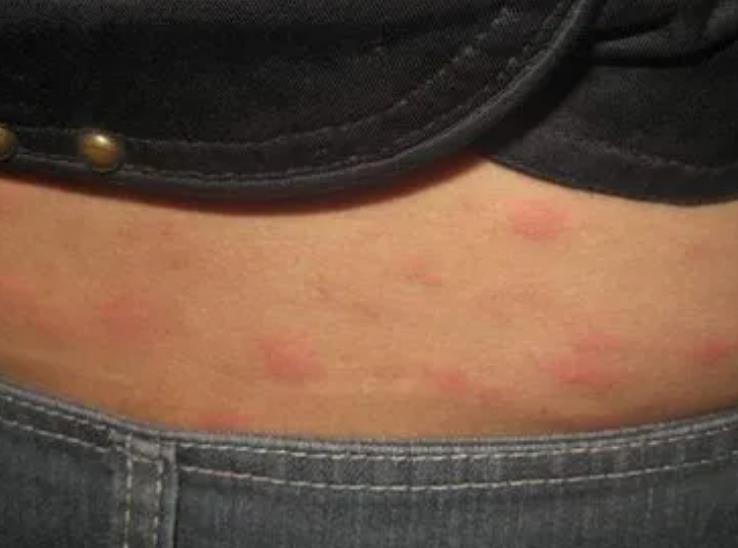 荨麻疹怎么治疗效果会很好?