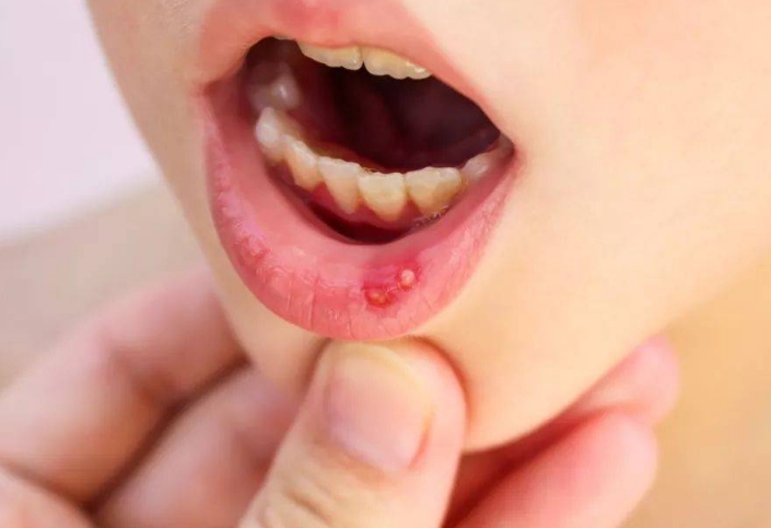 口腔溃疡最快最有效的方法有什么？