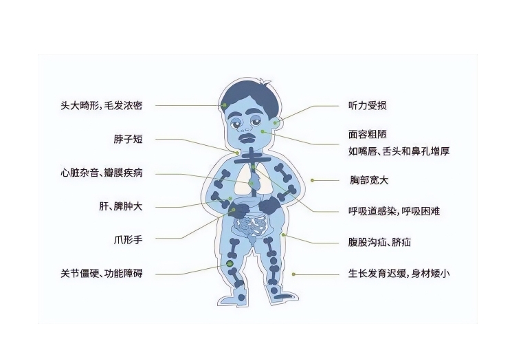 什么是粘多糖病？