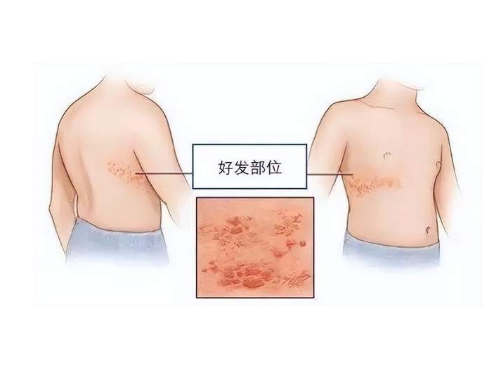 什么是带状疱疹？需要注意什么？