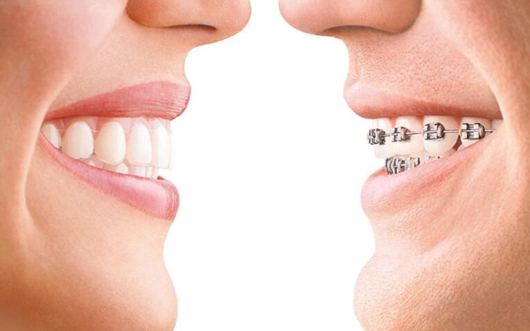 牙齿矫正的话大概需要花费多少钱？