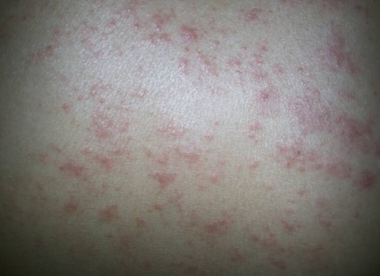 后背出现小红点很痒是怎么回事？