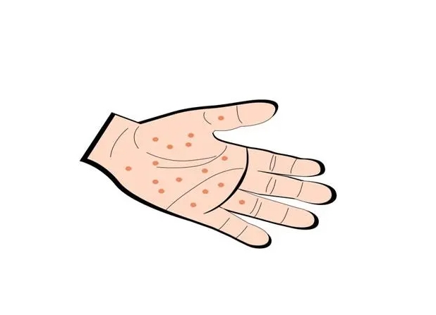 湿疹止痒有什么妙招吗