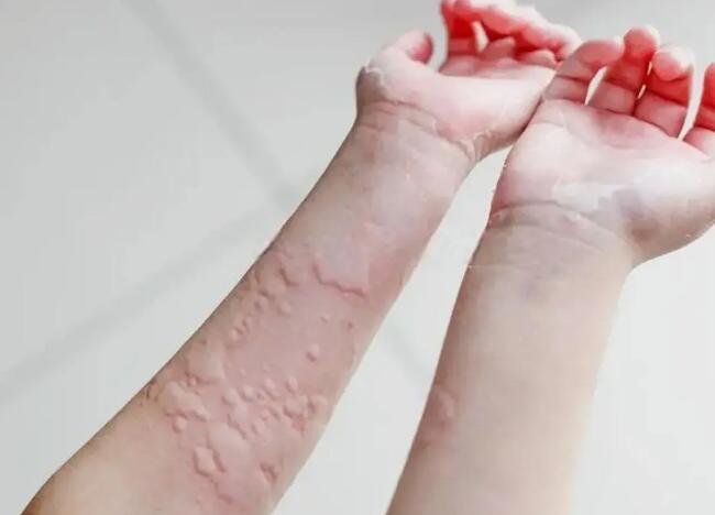 身上有荨麻疹是因为身体虚弱吗？荨麻疹会传染吗？