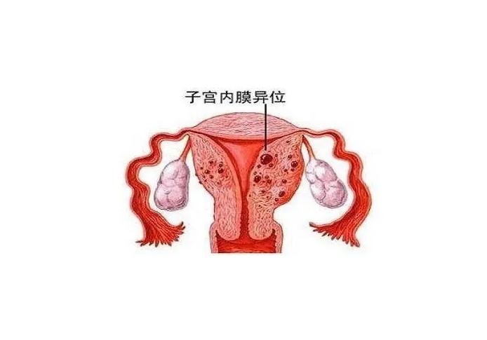 子宫内膜异位症能治好吗？复发的概率大吗？