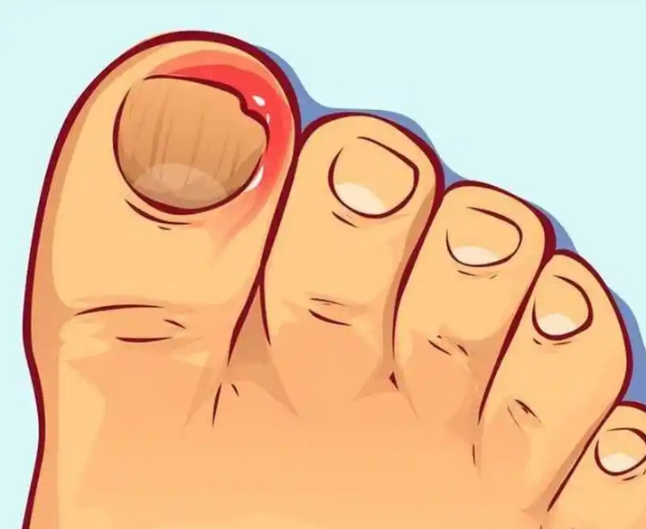 脚上的甲沟炎反复复发是什么原因？