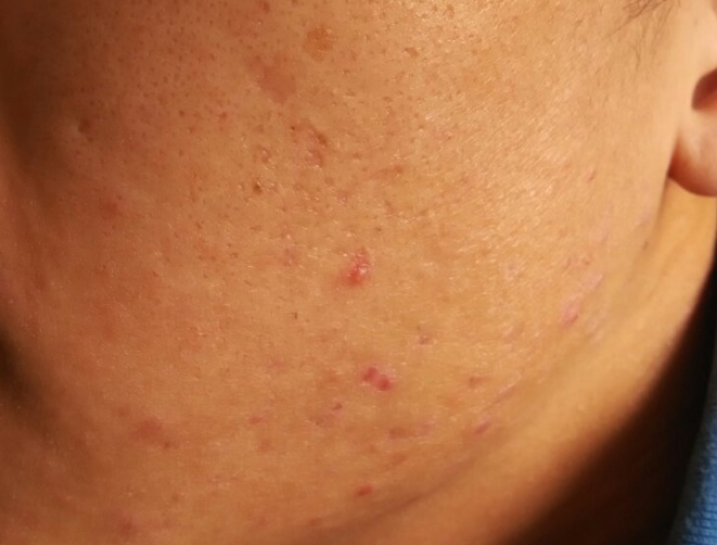 男生脸上的痘坑痘印怎么去掉或修复？