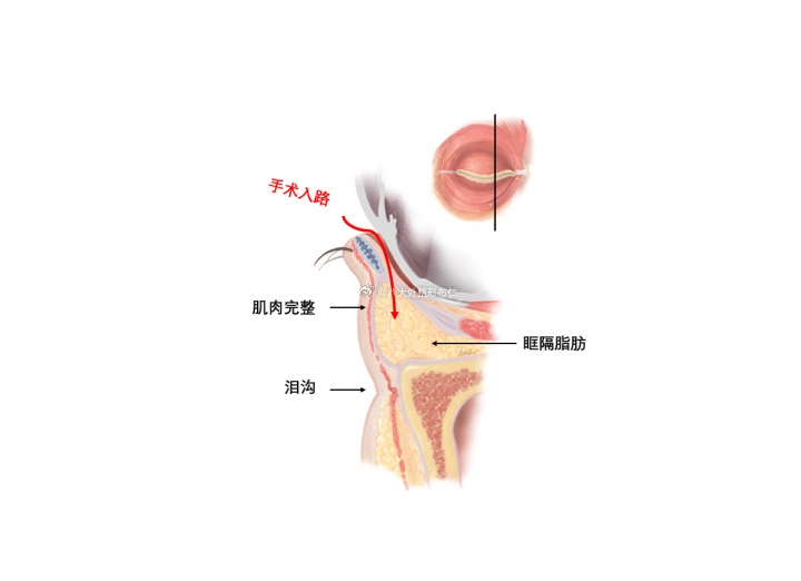 去眼袋手术有效果吗？能维持多少年？