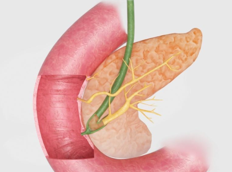 胰腺炎是什么原因引起的疾病？